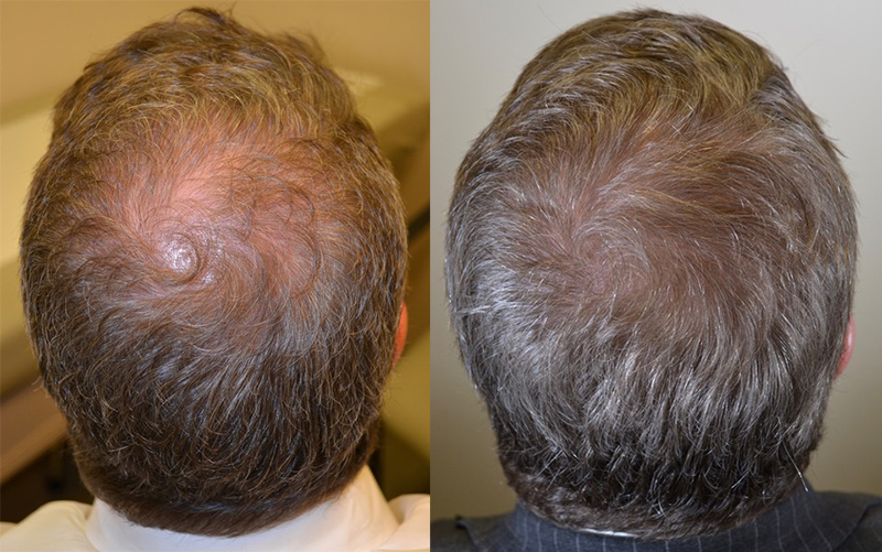 Before and after using Ora K