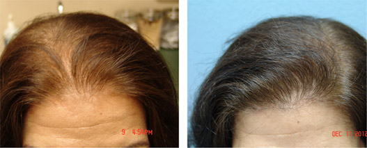 Before and after using Ora K