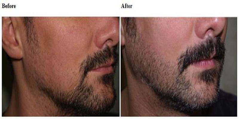 Before and after using Ora K