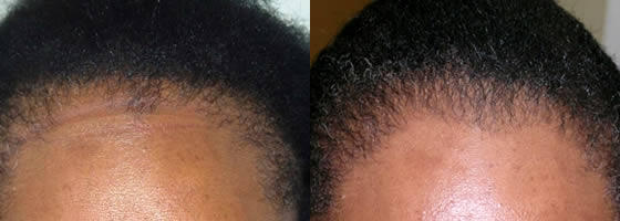Before and after using Ora K