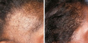 Before and after using Ora K