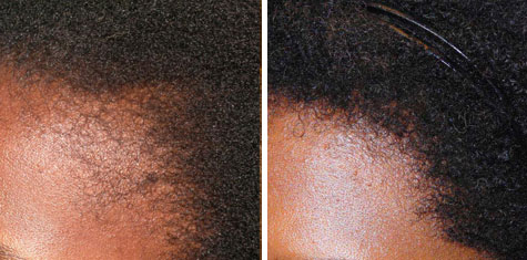 Before and after using Ora K