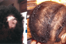 Before and after using Ora K